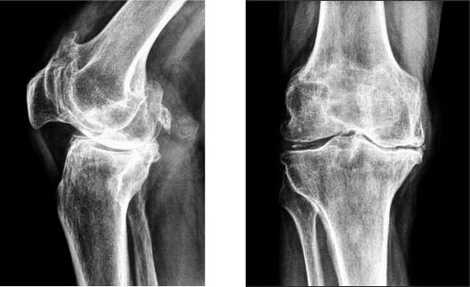 Kniegonarthrose im Röntgenbild