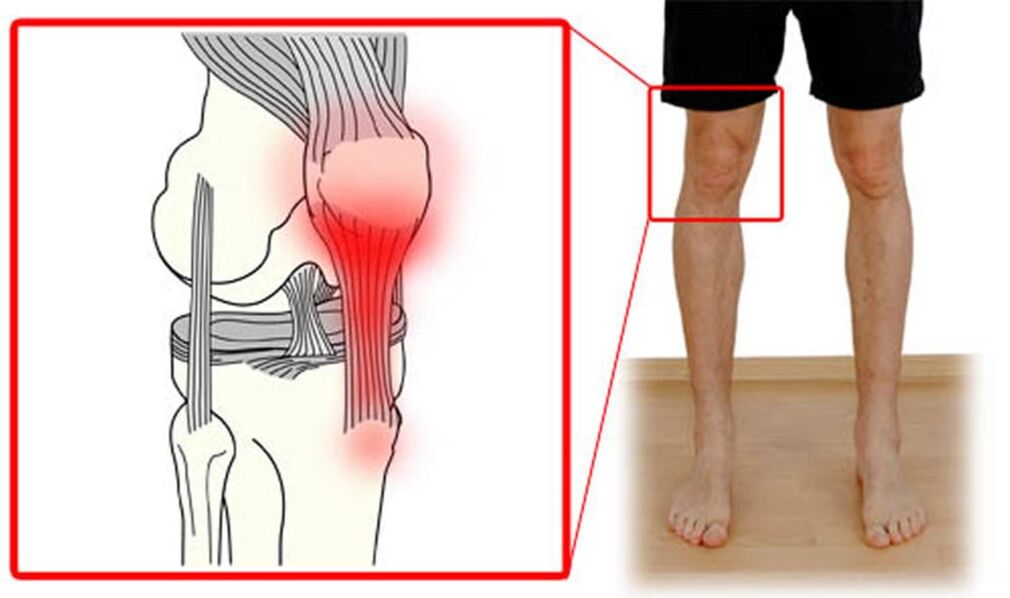 Tendinitis - Entzündung der Sehnen des Kniegelenks