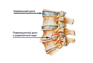 Die symptome der krankheit degenerative cervical disc