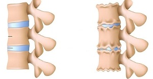 wie man das Vorhandensein einer Osteochondrose der Lendenwirbelsäule erkennt