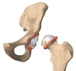 Ursachen für Arthrose des Hüftgelenks