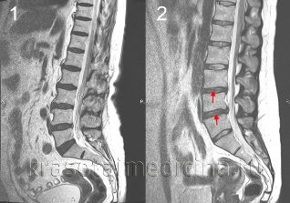 die osteochondrose der wirbelsäule